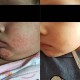 (Babies & Kids) Exzma Skincare Eczema & Psoriasis Relief Oil